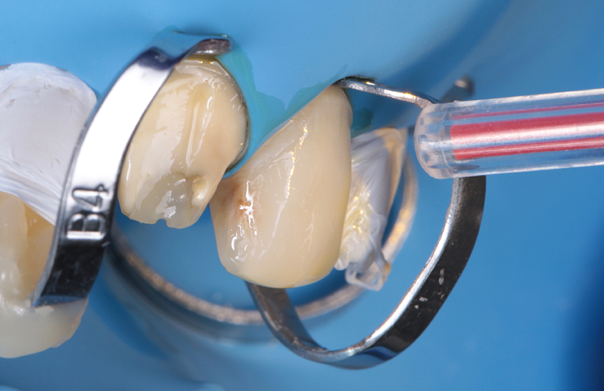 Lufttrocknen von 3M™ Scotchbond™ Universal Plus Adhäsiv. Bilder mit freundlicher Genehmigung von Dr. Paulo Monteiro.